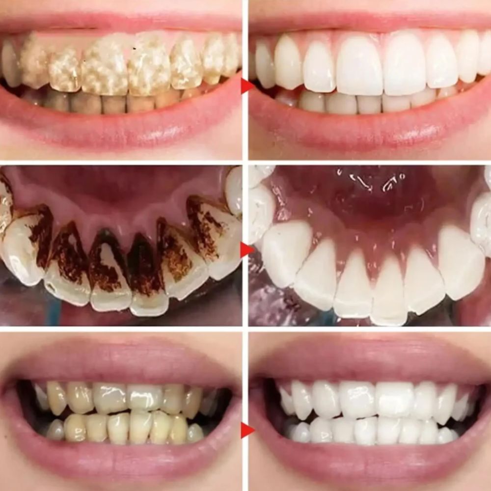 Aclarador Dental V34 Lilás - Luce Dientes Brillantes Ahora Mismo